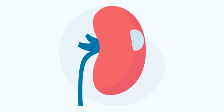 Киста почки