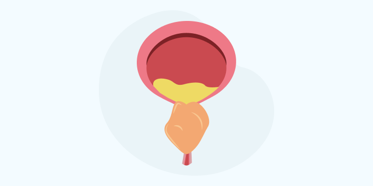 Аденома простаты