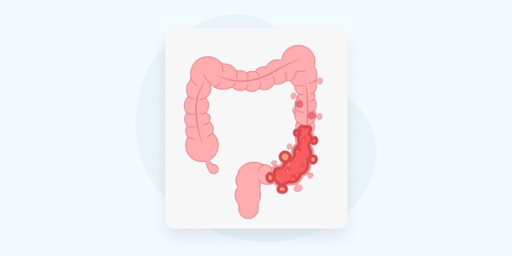 Дивертикулит