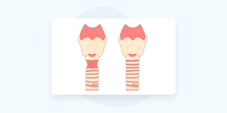 Стеноз трахеи