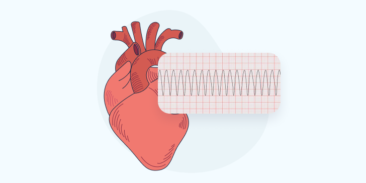 Пароксизмальная тахикардия