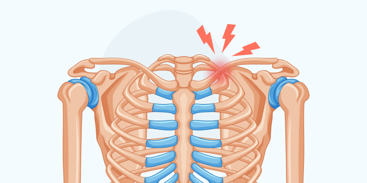 Перелом ключицы