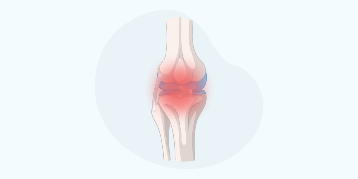 Синовит у детей