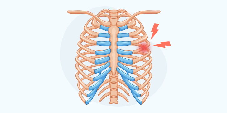 Перелом ребра