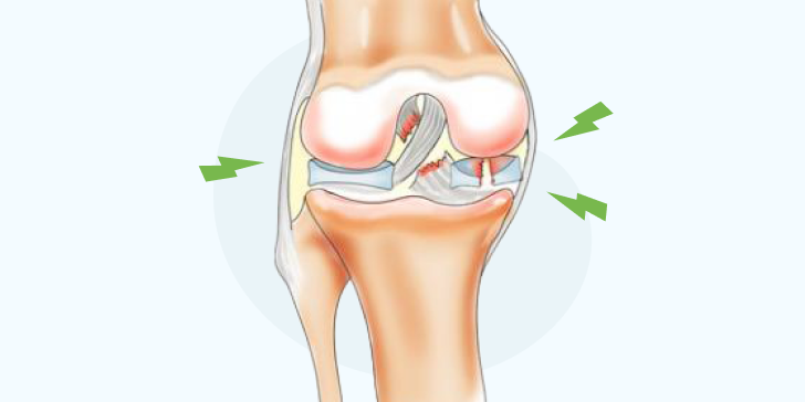 Разрыв мениска