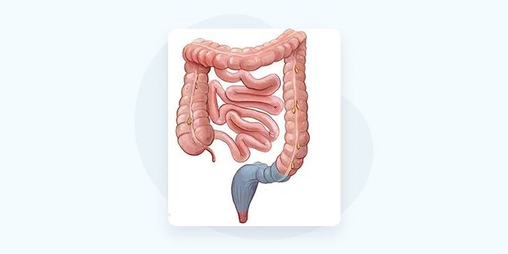 Резекция толстой кишки