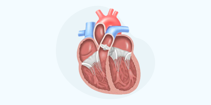 Дилатационная кардиомиопатия