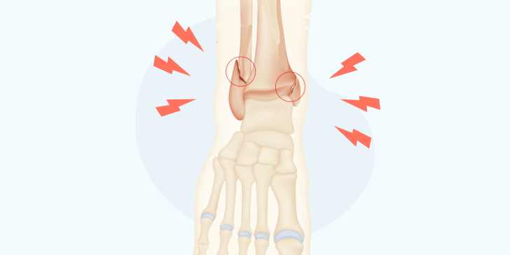 Перелом лодыжки