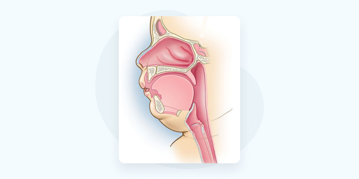 Ларингомаляция