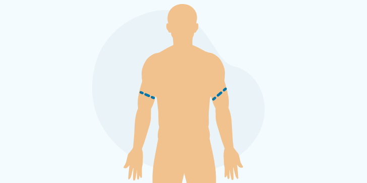 Ампутация рук