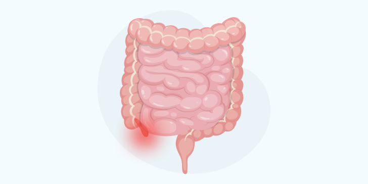 Острый аппендицит