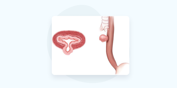 Дивертикул пищевода