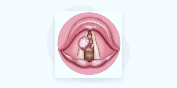 Киста гортани