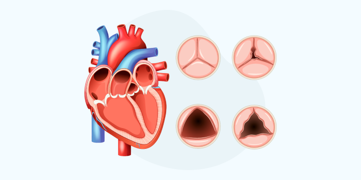 Стеноз аортального клапана