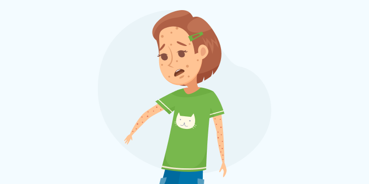 Экзантема у детей