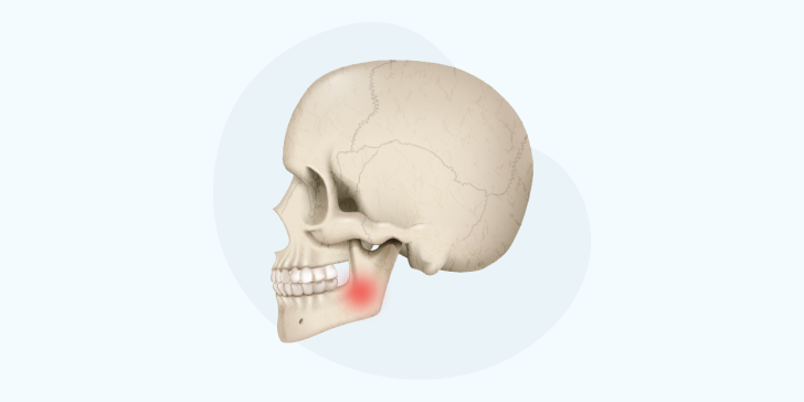 Остеомиелит челюсти