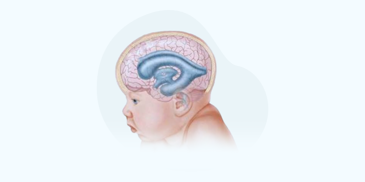 Гидроцефалия у детей