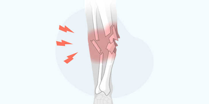 Перелом малоберцовой кости