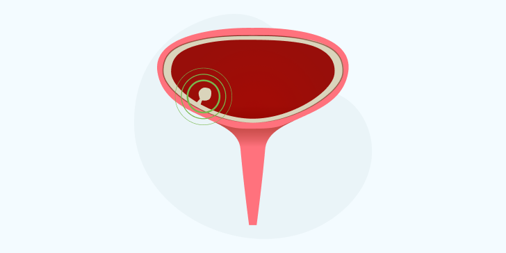 Полип уретры