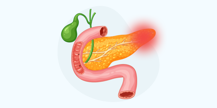 Острый панкреатит
