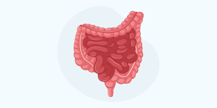 Кишечная непроходимость