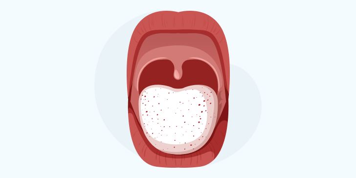 Кандидозный стоматит у детей