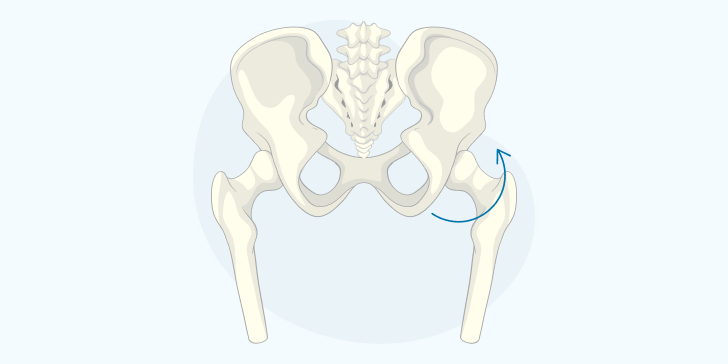 Вывих бедра