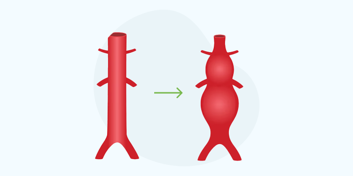 Аневризма аорты