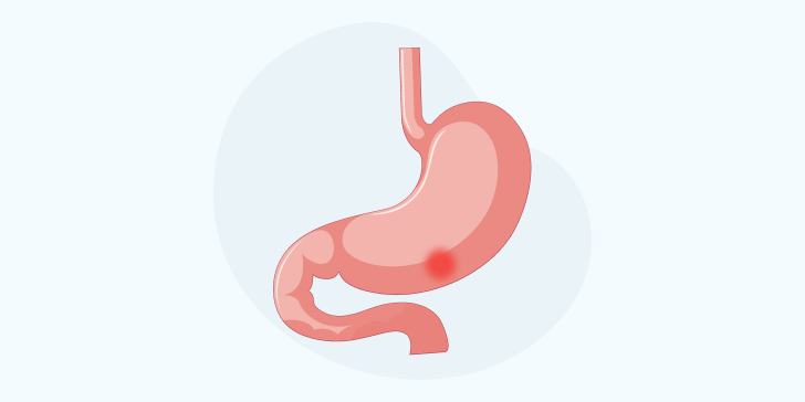 Прободная язва желудка