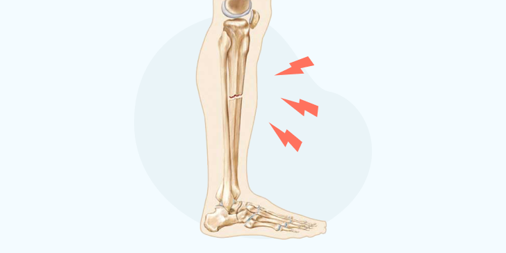 Перелом ноги со смещением