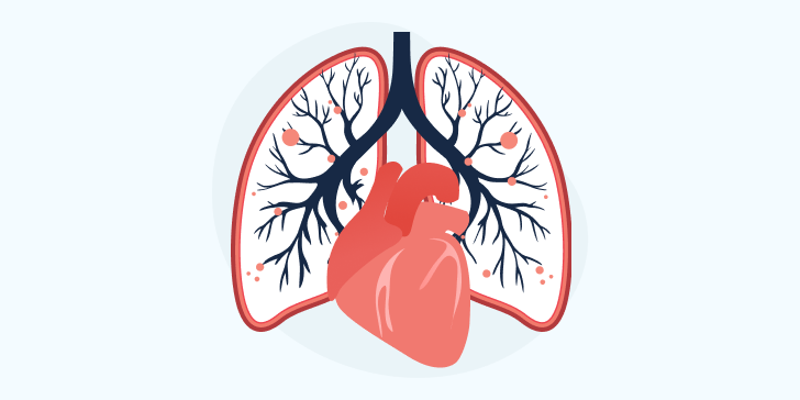 Легочное сердце