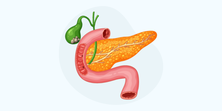 Калькулезный холецистит