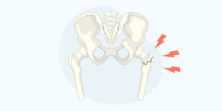 Переломы бедра