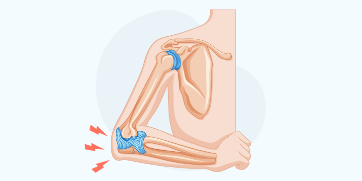 Перелом локтя