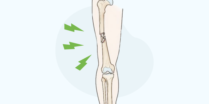 Оскольчатый перелом