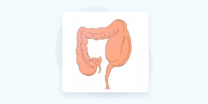 Болезнь Гиршпрунга