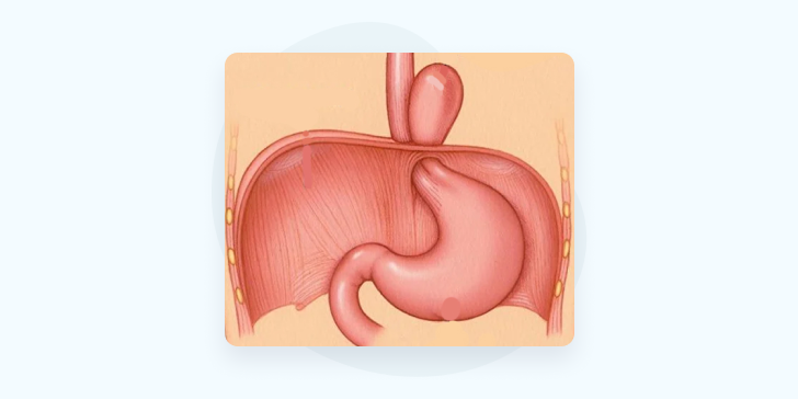 Грыжа пищеводного отверстия диафрагмы (ГПОД)