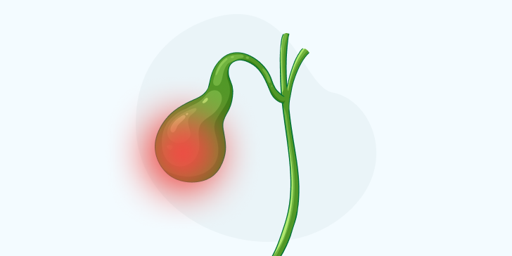 Острый холецистит