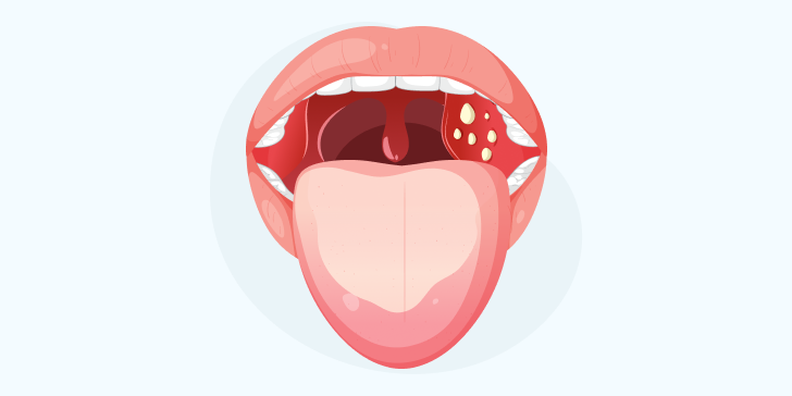 Паратонзиллярный абсцесс