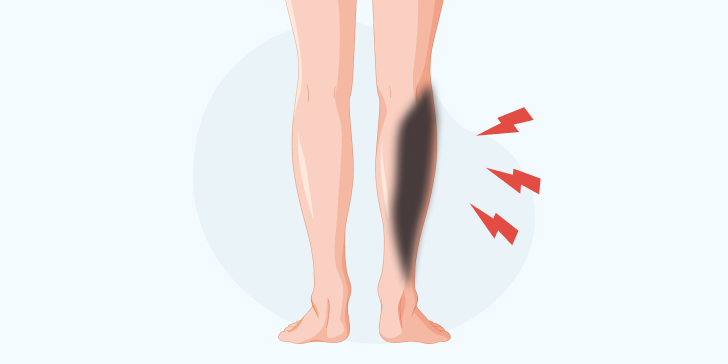 Газовая гангрена