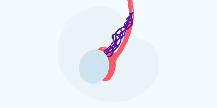 Варикоцеле