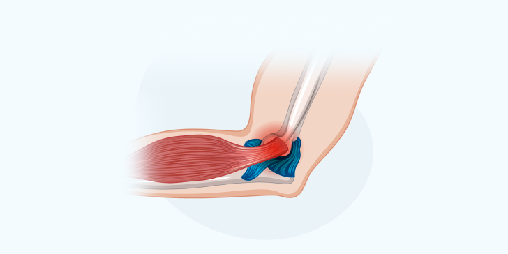 Разрыв связок