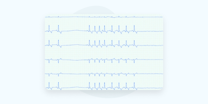 Синдром слабости синусового узла