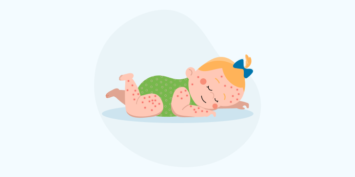 Экссудативный диатез