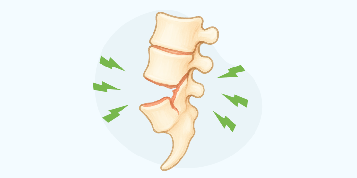 Перелом копчика