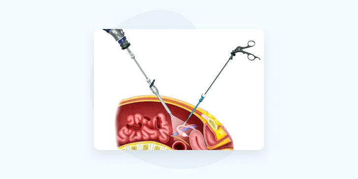Лапароскопические операции