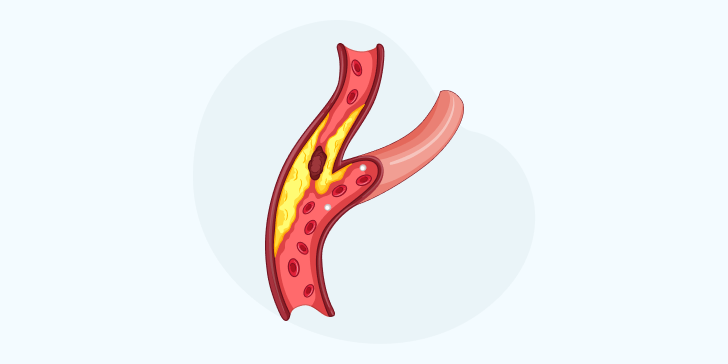 Атеросклероз сонных артерий