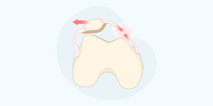 Вывих коленного сустава
