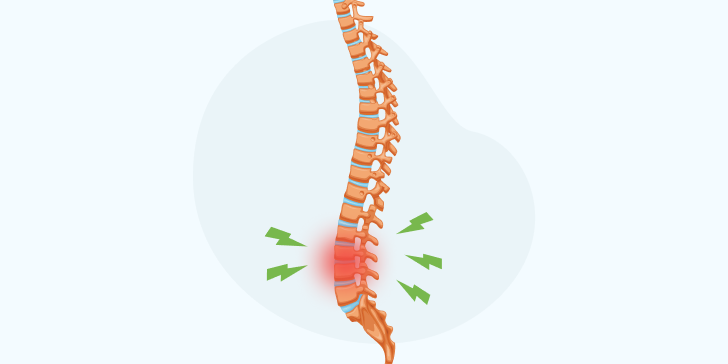 Межпозвоночная грыжа поясничного отдела