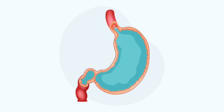Гастроэзофагеальная рефлюксная болезнь (ГЭРБ)